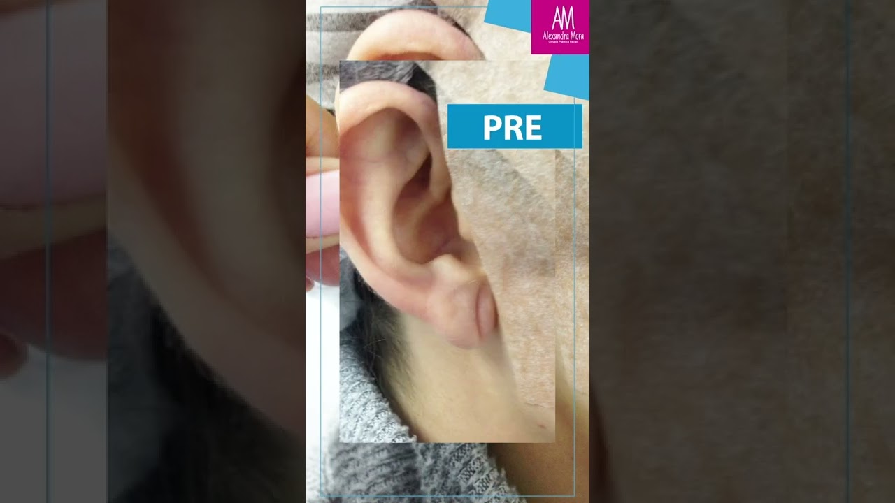 cerrar agujero oreja rasgado seguridad social