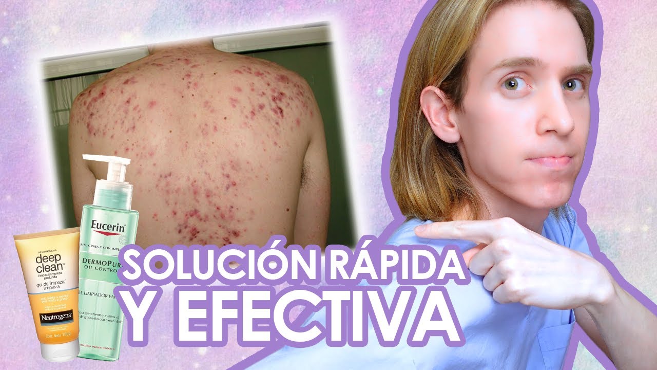 como quitar los granos dela espalda en 3 dias