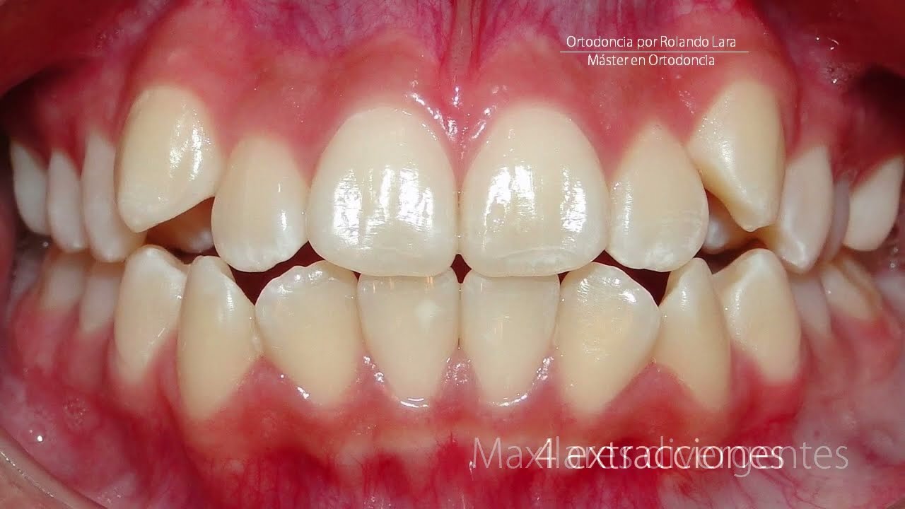 no me gustan mis dientes después de la ortodoncia